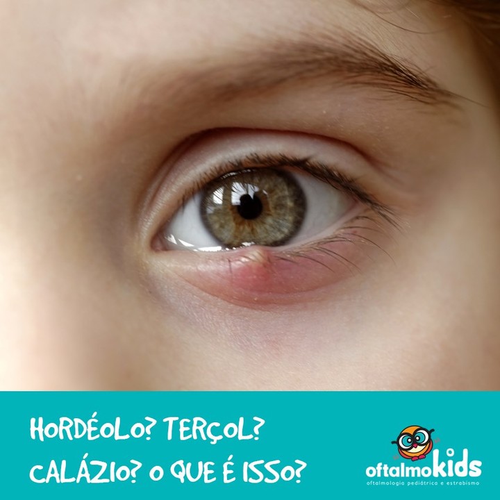 Clinica de Olhos Martinho Campos - 🛑Hordéolo. o hordéolo pode se